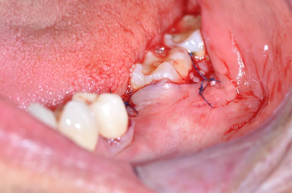 Proceso de Implante Dental